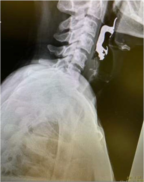 Lateral neck X-ray showing radio-opaque object in the upper airway.