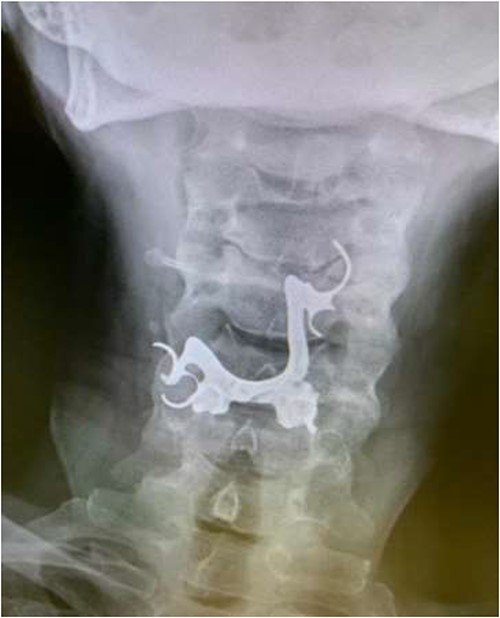 Anterior-posterior neck X-ray showing a radio-opaque object, in keeping with metal dentures.