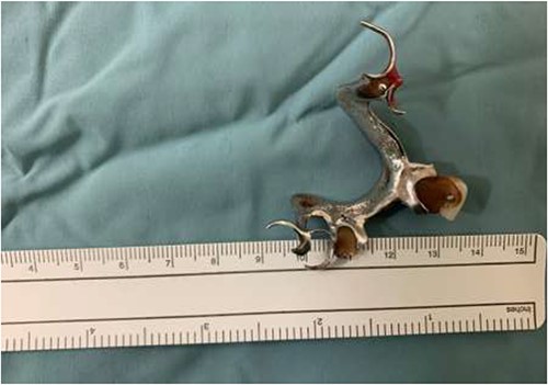 Successful removal of metal dentures.