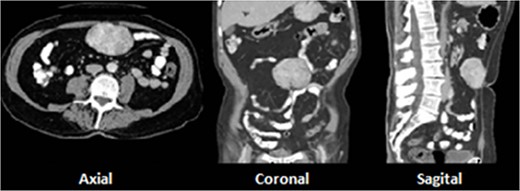 A 9-cm solid preperitoneal lesion at umbilical level.