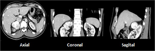 A 5.4-cm lesion in right adrenal gland.