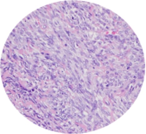 Spindle cell neoplasm with collagen bundles and capillary vascularization.