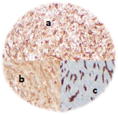 Immunohistochemical analysis – vimentin+ (a), Bcl-2+ (b) and CD 34+ (c).