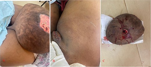 (A) Clinical photograph showing giant lipofibroma arising from the inguinal region with a stalk. (B) Post complete excision. (C) Resected (giant) lipofibroma.