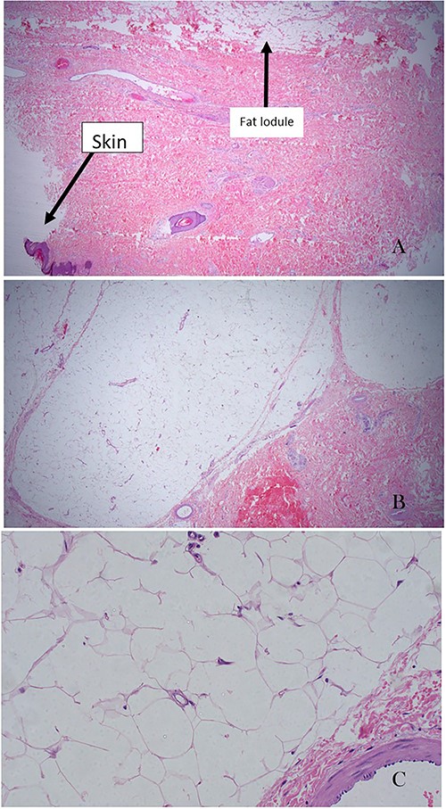 (A) Ulcerated skin and the lobules of mass with fat tissue (×20 magnification). It is also showing ulceration on the adjacent skin. (B) Lobules of fat tissue compressing the adjacent dermal collagenous tissue. There are groups and strands of mature adipocytes extending between collagen bundles of the dermal layer of the skin (×20 magnification). (C) High-power field of adipose tissue with mature adipocytes and without atypia. Adipocytes have small eccentric nuclei with minimal atypia in a perivascular space (×200 magnification).