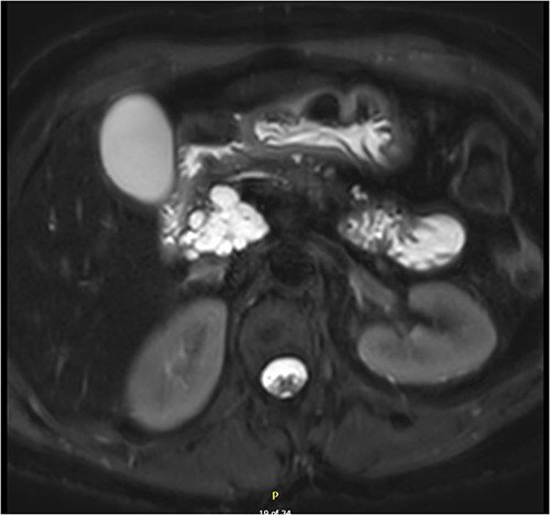 Multi-loculated head of pancreas cyst, with no pancreatic duct dilation.