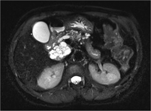 Increased diameter of lesion and dilation of main pancreatic duct on interval MRI.