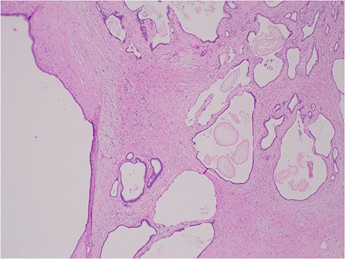 Hematoxylin and Eosin (H&E) × 40 showing benign cysts and luminal eosinophilic concretions.