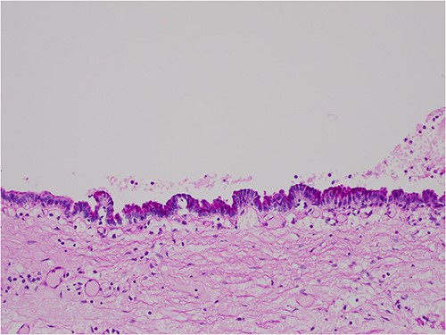 PASD × 200 showing positive apical staining in cyst-lining epithelial cells, indicating acinar differentiation.