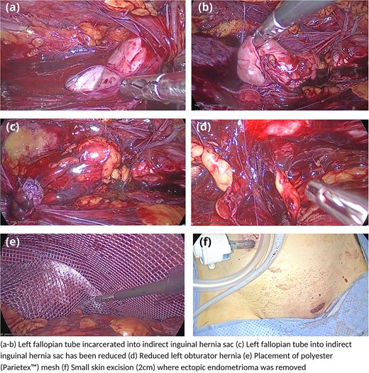 Laparoscopic images demonstrating incarcerated left fallopian tube, left obturator hernia, microscopic endometrioma and Parietex™ mesh placement.