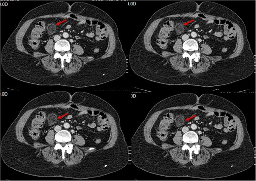 Small intra-peritoneal ovoid fatty mass, well limited by a thin border «Ring Sign/ central dot sign», enhanced after contrast, surrounded by inflammatory changes.