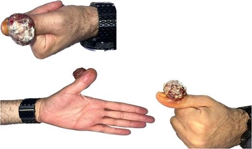 Exophytic mass over the left thumb at the level of the IPJ.