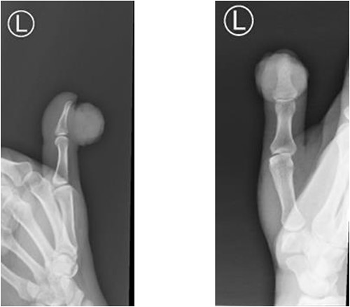Radiopaque soft tissue swelling over the IPJ of the left thumb without bony involvement.