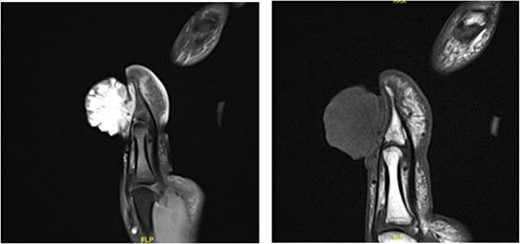 Large hypervascular exophytic lesion of distal thumb, no signs of the bony invasion.