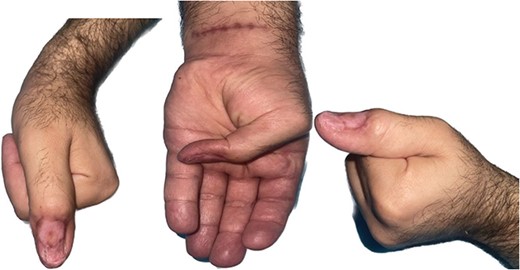 Three months post-operation, showing a good aesthetic and functional result.