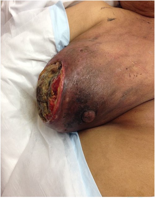 The fungating lesion on the right breast.