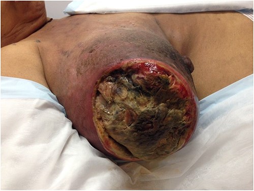 The fungating lesion on the right breast.