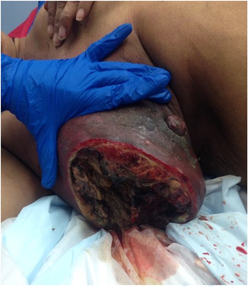 The auto-amputation of the same lesion after 2 days.