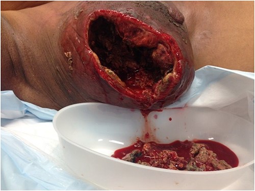 The resultant cavity.