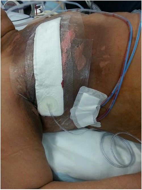 The figure was taken after the surgery (right salvage mastectomy with level 2 axillary dissection) with vacuum dressing and drains in situ.