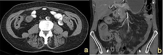 CT abdomen showing (a) thickened ascending colon wall and (b) thickened caecum and transverse colon (indicated by white arrows).