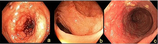 Colonoscopy demonstrating (a) ascending colon lesion, (b) hepatic flexure mucosal abnormality and (c) cobblestoned mucosa in the transverse colon.