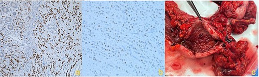 IHC staining showing (a) Gata3 positive cells, (b) ER positive cells and (c) macroscopic hemicolectomy specimen with diffuse infiltrative ILC.