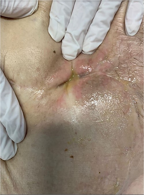 The surgical wound showed a fetid odor and color changes.