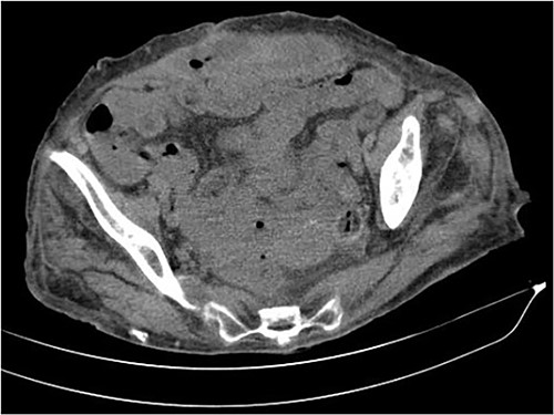 The axial CT section of the abdomen showing an abscess in the abdominal wall adjacent measured 12 × 4.0 × 13.0 cm.