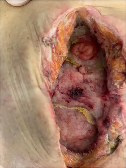 Entero-atmospheric labial fistula.