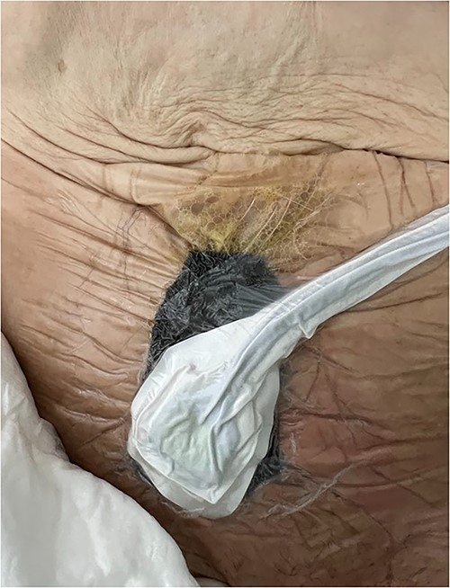 A vacuum dressing was then placed with a pressure of 70 mmHg and later changed to 100 mmHg.