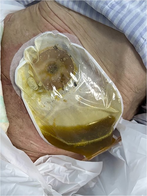 A karaya bag was placed and guided by vacuum therapy and stomahesive for skin protection.