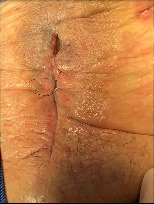 The patient had reduced drainage and an oriented fistula without chemical dermatitis.