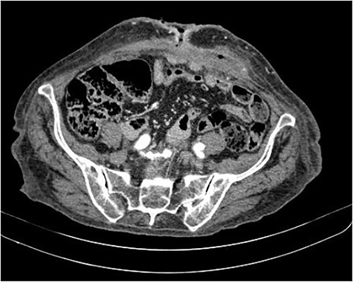 The axial CT section of the abdomen shows the loops in contact with the anterior abdominal wall at the level of the scar umbilical cord. The collection decreased compared with the previous CT scan in the subcutaneous tissue of the umbilical region.