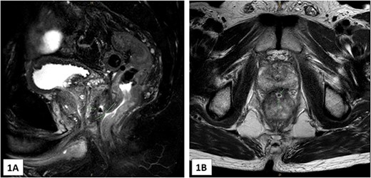 (A) and (B)—MRI images (A in sagittal, B in axial) showing the 3 mm tract from the low rectum extending into the recto-prostatic angle. This is in connection with a small collection at the recto-prostatic angle.