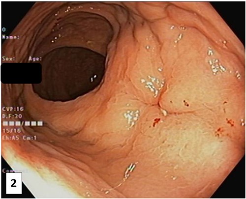 Photograph of the anterior rectal wall taken at colonoscopy after the SpaceOAR Vue was noted to be missing. This lesion, likely a healing sinus, corresponds to the location of the abnormality of the pelvic MRI.