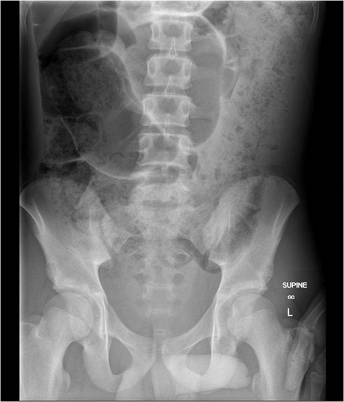Abdominal plain X-ray demonstrated dilated loops of colon and ‘coffee-bean sign’.