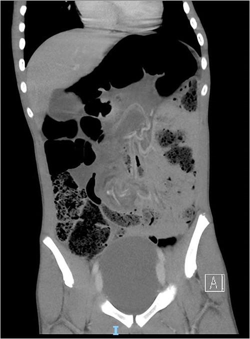 Computed tomography demonstrated a mesenteric ‘whirl sign’ around the inferior mesenteric artery and sigmoid mesentery. Dilated loops of sigmoid colon with proximal faecal loading.