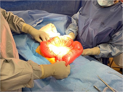 Intraoperative photograph demonstrating sigmoid volvulus.