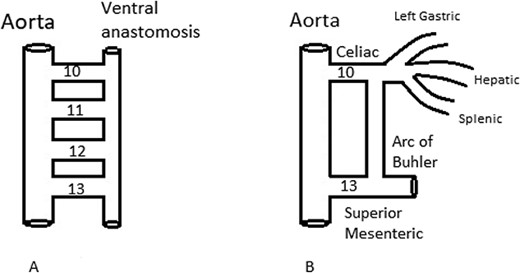 (A) Vitelline arteries 10th–13th communication between the aorta and the ventral anastomotic artery. (B) The arc of Buhler, embryological remnant of the ventral anastomosis, connecting the CA and SMA, despite the regression of the 11th and 12th vitelline arteries.