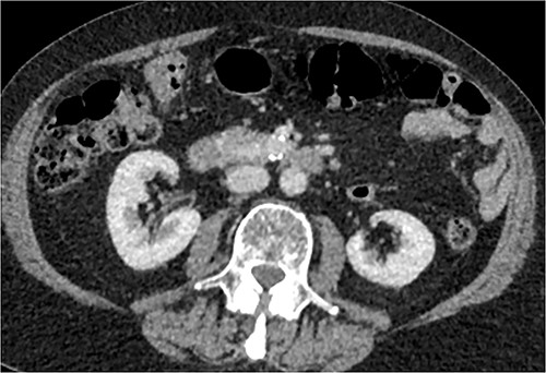 Initial CT: axial view, demonstrating what was initially thought to represent indeterminate pancreatic/duodenal lesion.