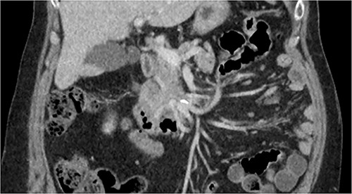 Initial CT: coronal view of a 13 mm hyperattenuating region with peripheral calcification at the inferior margin of the pancreatic uncinate process and the superior margin of the duodenum.