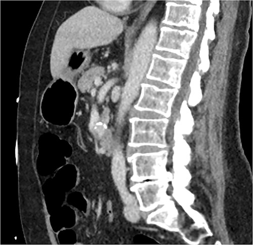 Initial CT: sagittal view of the indeterminate pancreatic/duodenal lesion.