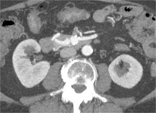 Multiphase CT pancreas, axial view demonstrating abnormal communication between the CA and the SMA.