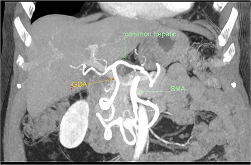 Multiphase CT pancreas, coronal view: the gastroduodenal artery, off the common hepatic, communicating with the first branch of the SMA.
