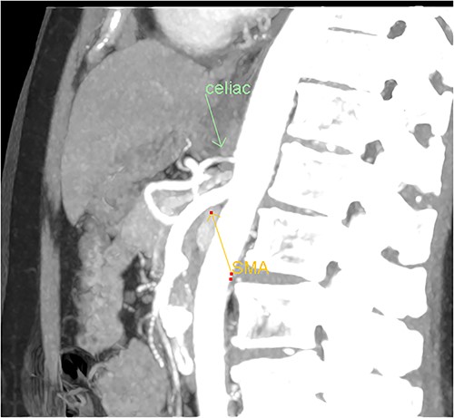 Multiphase CT pancreas, sagittal view: abnormal communication between the CA and the SMA. The celiac axis is markedly narrowed, >90%.