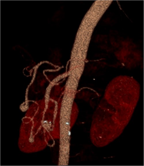 3D reconstruction demonstrating abnormal communication between the CA and SMA.