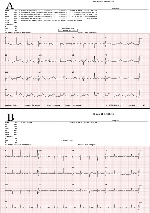 (A) ECG at presentation, before thrombolysis, STE in leads II, III and aVF. (B) ECG post-NG decompression of distended bowel.