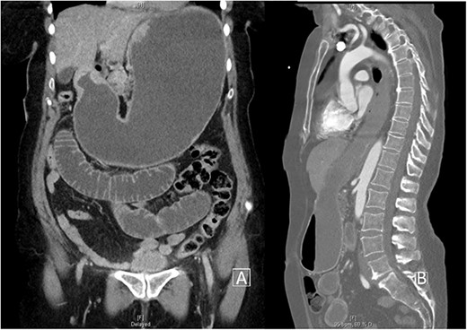 (A) Coronal CT cross-section demonstrating gross bowel and stomach distension. (B) Sagittal CT cross-section demonstrating obstruction and reflux of stomach contents into oesophagus.