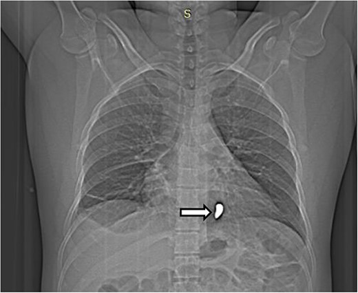 Scout image of the chest showing a radio-opaque foreign body in the left side of the chest (white arrow).
